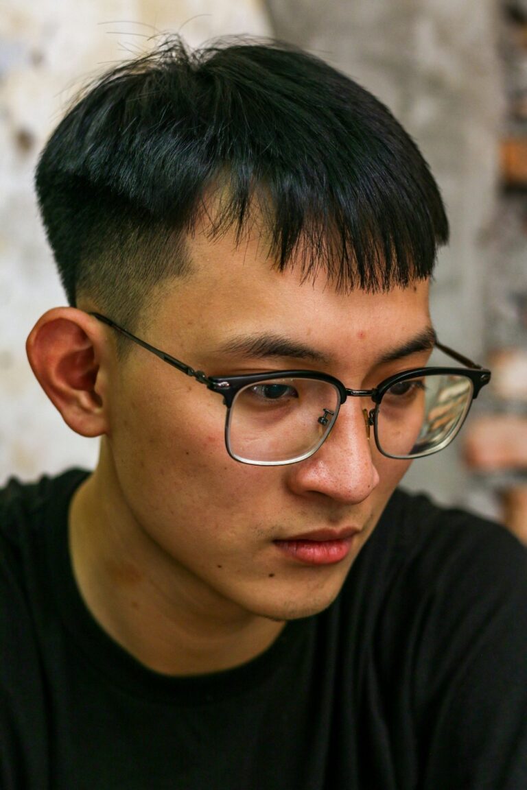 頭皮護理案例－髮線問題示意圖